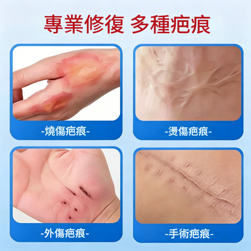 修正醫用矽酮祛疤膏,用於燒傷燙傷、手術疤痕、去除增生修復凝膠 修正醫用矽酮祛疤膏,用於燒傷燙傷、手術疤痕、去除增生修復凝膠